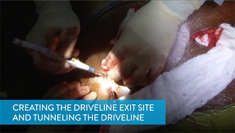 Creating the Driveline Exit Site and Tunneling the Driveline Video