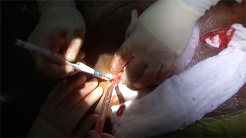 Creating the Driveline Exit Site and Tunneling the Driveline Video