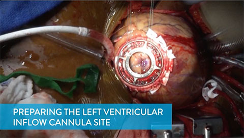 Preparing the Left Ventricular Inflow Cannula Site Video