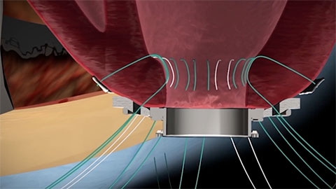 Preparing the Left Ventricular Inflow Cannula Site Video