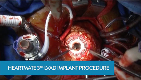 HeartMate 3 Implant Procedure Overview