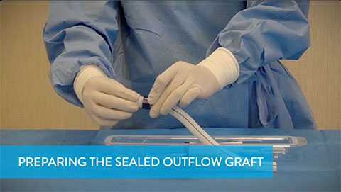 Preparing the Sealed Outflow Graft Video