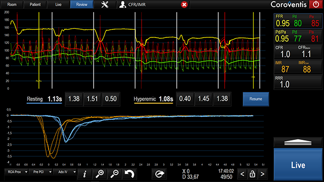 Intuitive touch screen with the CoroFlow‡ Cardiovascular System