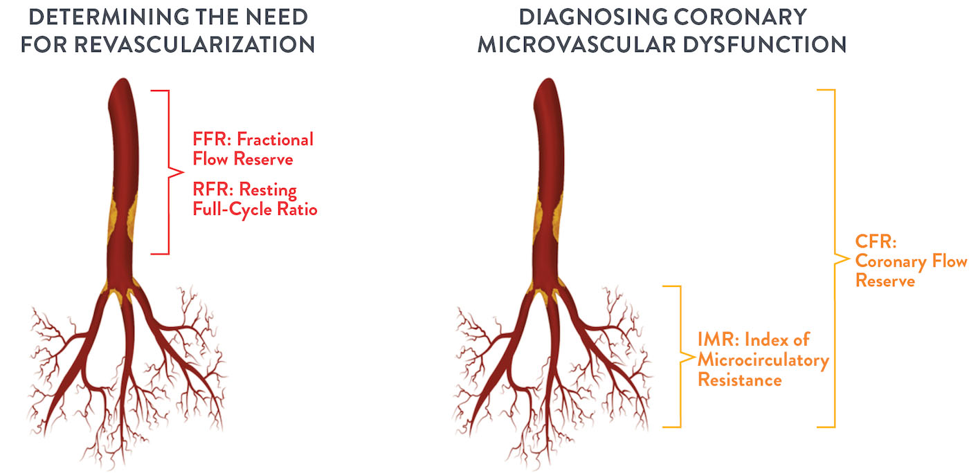 FFR and RFR™ assess epicardial hemodynamics; IMR and CFR assess coronary microvascular dysfunction 