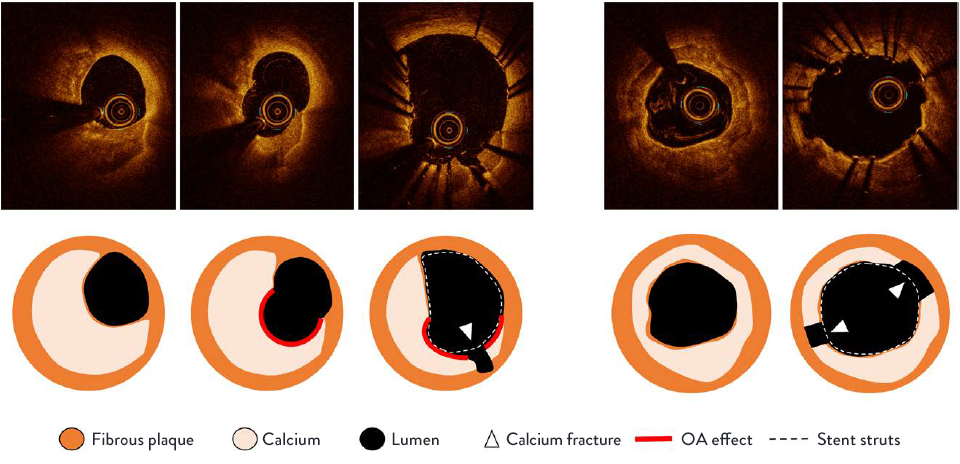 Calcium fracture with and without OA effect