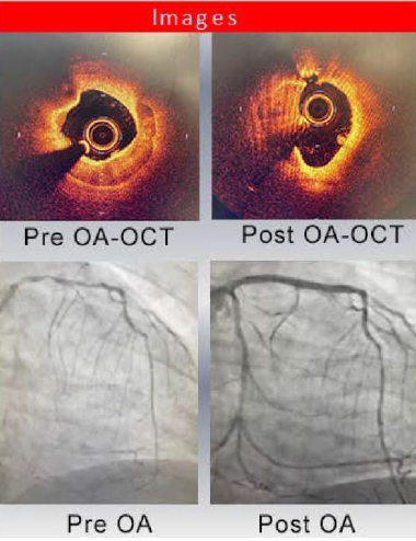 Observational study evaluating the efficacy of OA in treating calcified coronary lesions