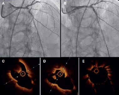 Orbital atherectomy for calcified nodule: optical coherence tomography assessment