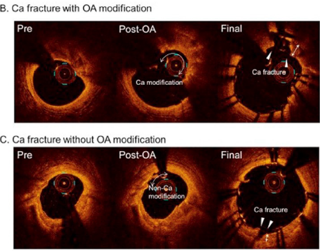 Ca fracture with OA modification