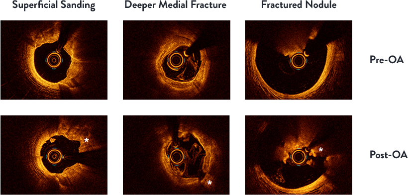 Pre-OA and Post OA lesions