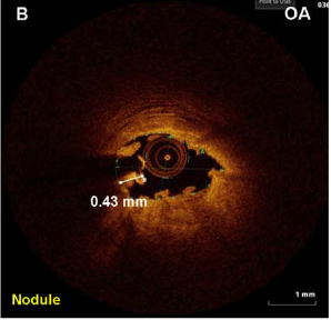 OA achieves deeper tissue modifications than RA