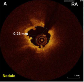 OA achieves deeper tissue modifications than RA