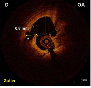 OA achieves deeper tissue modifications than RA