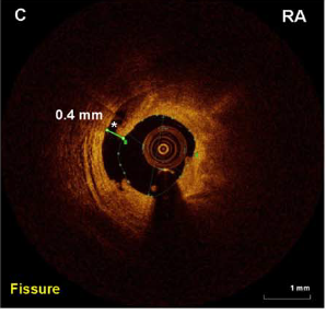 OA achieves deeper tissue modifications than RA