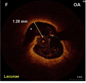 OA achieves deeper tissue modifications than RA