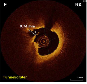 OA achieves deeper tissue modifications than RA