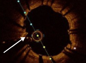 Post-Stent