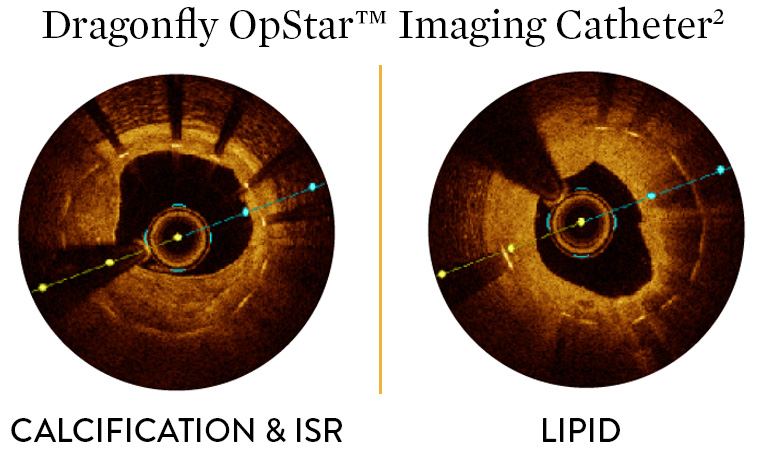 Dragonfly OpStar imaging catheter provides brighter images