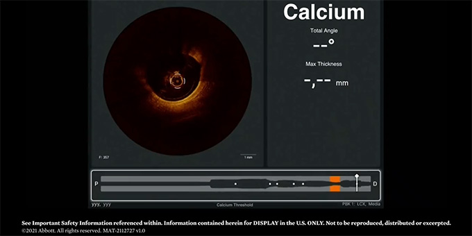 Calcified lesions