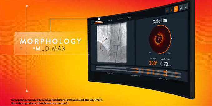 Perform OCT guided PCI