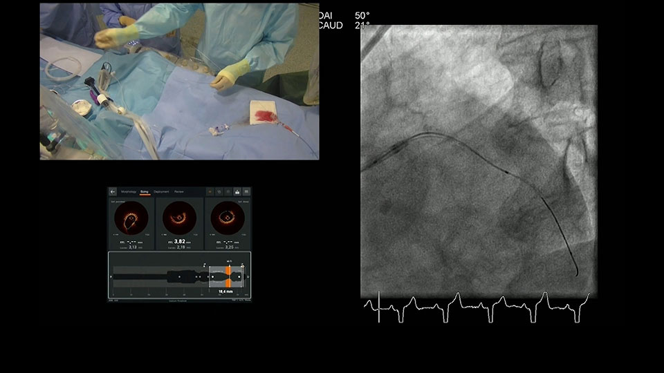 Ultreon 1.0 Software Modify Calcific Plaque