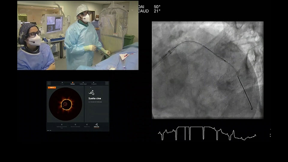 Ultreon 1.0 Software Coronary Calcium