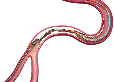 XIENCE Sierra stent now offers best-in-class deliverability.