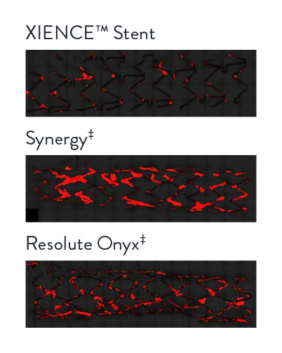 XIENCE Stent comparison