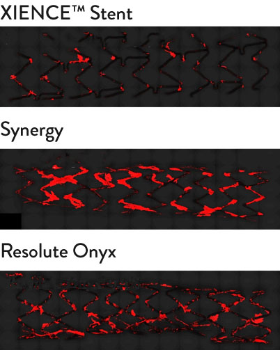 XIENCE Stent comparison