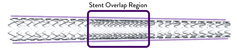  XIENCE Skypoint 48-mm Stent for long lesions can preclude the need for multiple overlapping stents.