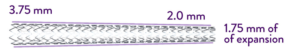 XIENCE Skypoint DES Stent for Small Tapered Vessel Placement