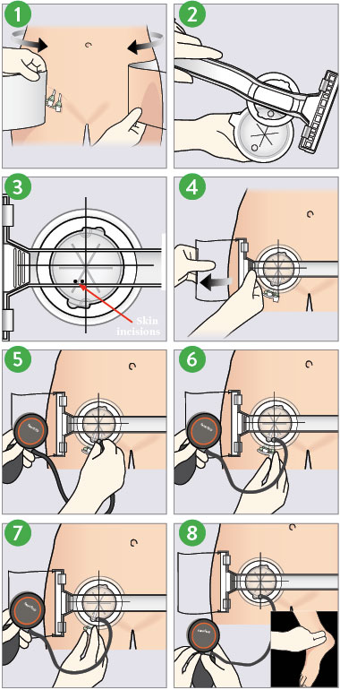   Deployment illustration