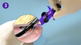  Pull back plunger (deploy suture)