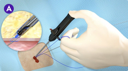  Suture Management Step A