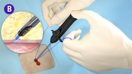   Suture Management Step B