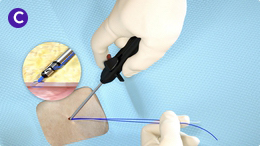   Suture Management Step C