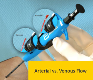 Poor Flow Arterial