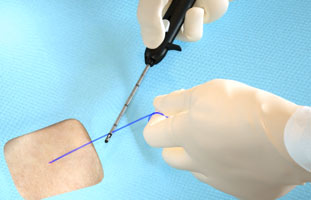  Suture Break Prevention