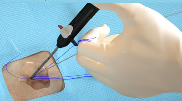  Suture Break Prevention