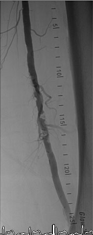 Long, Calcified Superficial Femoral Artery 2