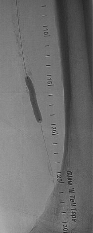 Long, Calcified Superficial Femoral Artery 3