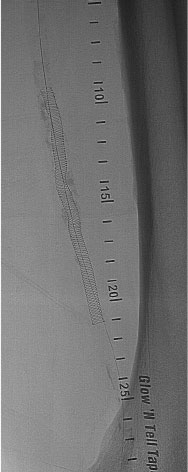 Long, Calcified Superficial Femoral Artery 4