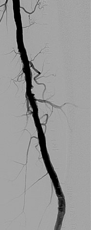Long, Calcified Superficial Femoral Artery 5