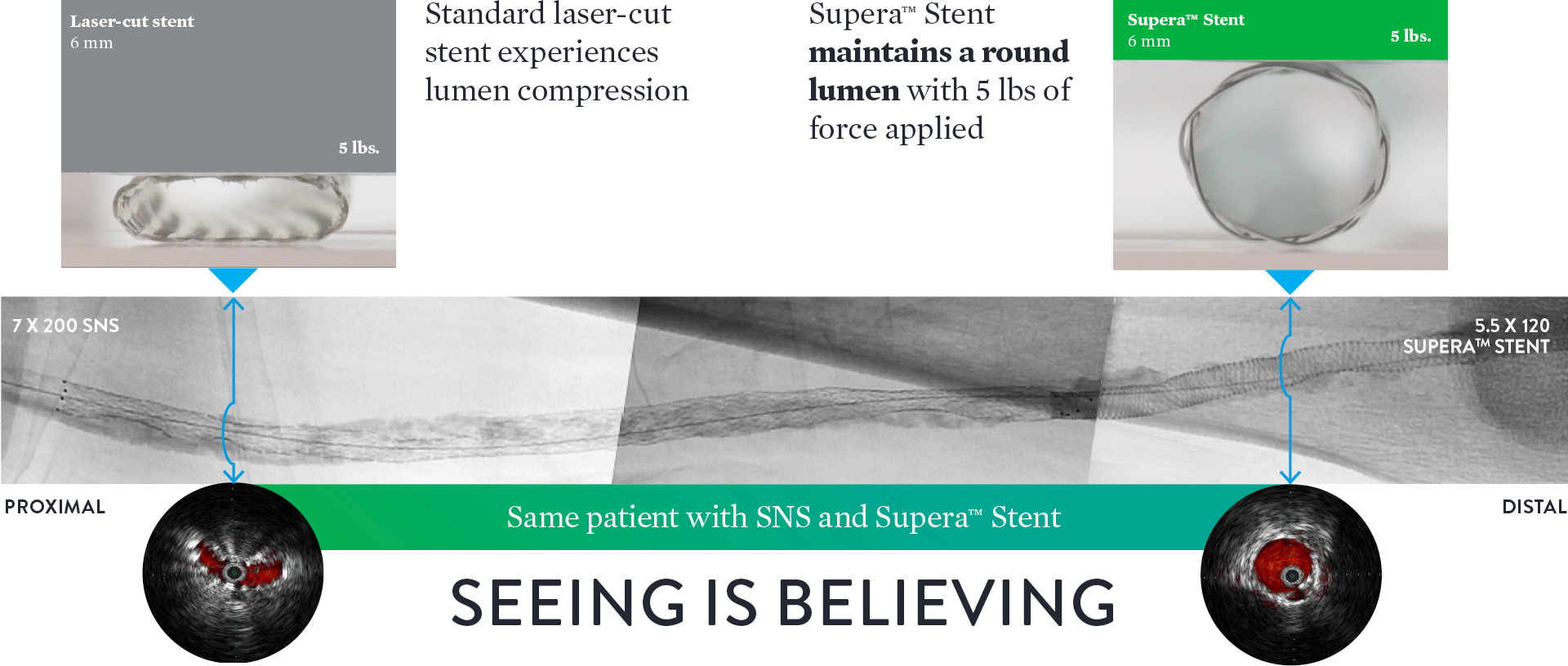   Laser-cut stent vs. Supera stent