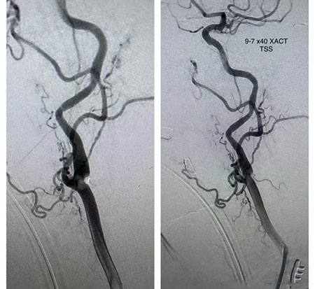Angiogram ICA image