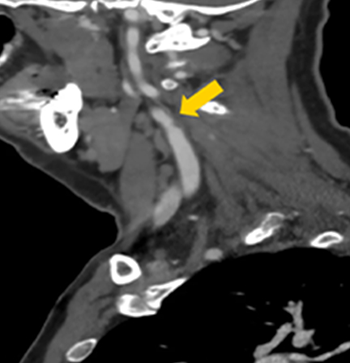 CTA Neck image