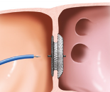 Amplatzer Septal Occluder