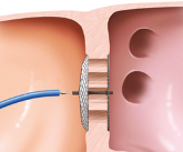 Amplatzer Septal Occluder