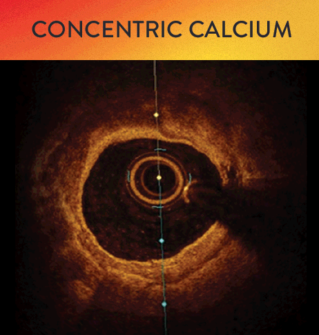 OCT classification of concentric calcium