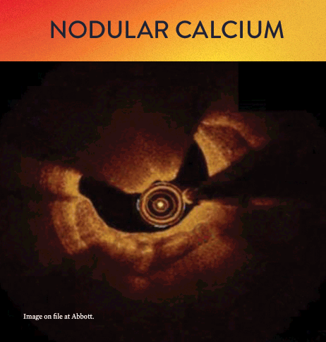 OCT classification of nodular calcium