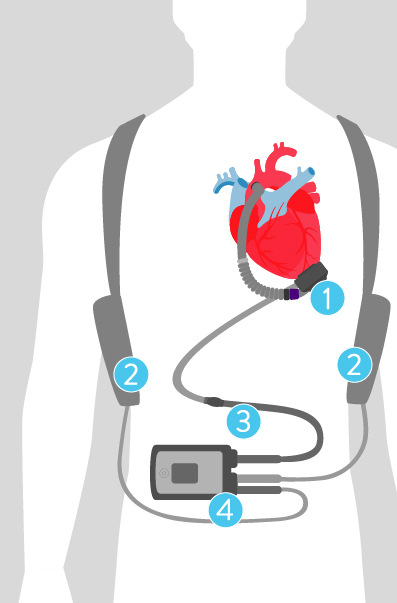 LVAD HeartMate 3